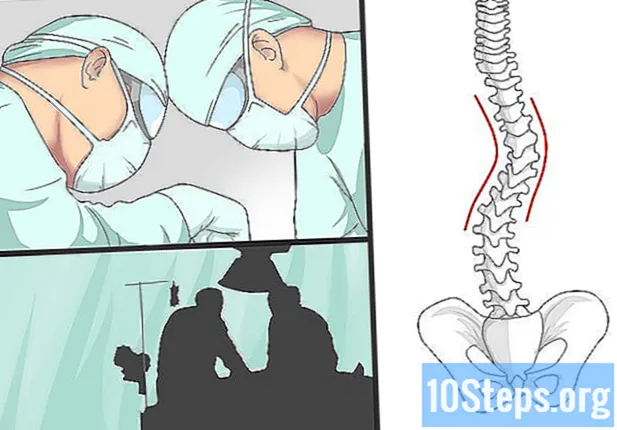 척추 측만증에서 허리 통증을 완화하는 방법