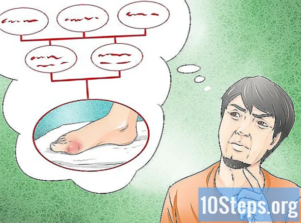 Cara Melegakan Gejala Gout di Rumah