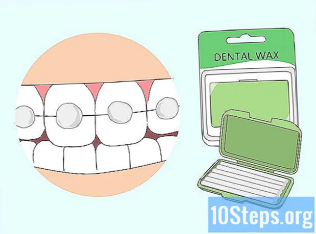 歯列矯正器でキスする方法