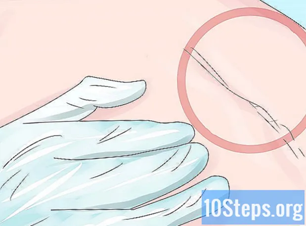 Как да премахнете хирургически скоби
