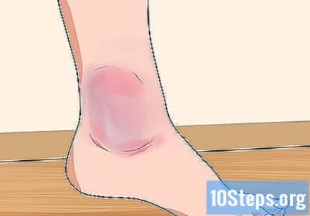 Najčešće ozljede koljena - koji su uzroci i kako se boriti s njima? | sarahbband.com