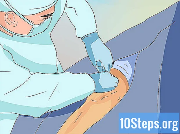 Πώς να αντιμετωπίσετε ένα διάστρεμμα στο γόνατο