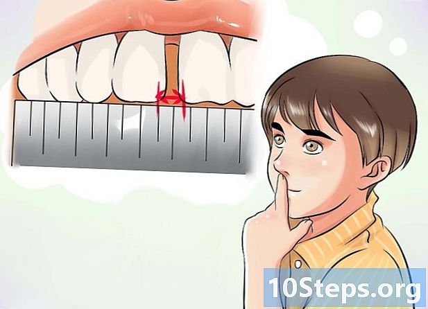 Como corrigir dentes quebrados