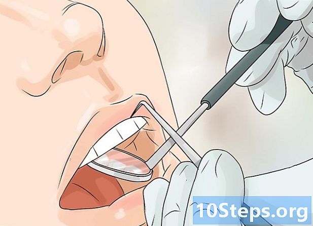Làm thế nào để tránh sâu răng - Làm Thế Nào Để