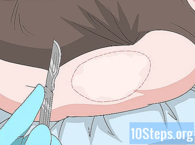 Ako zabrániť tomu, aby sa vitiligo zhoršovalo