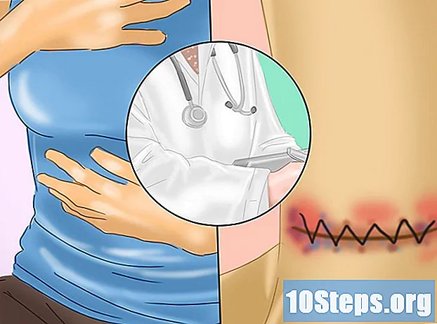 Hoe zorg je voor de incisie na een schildklieroperatie