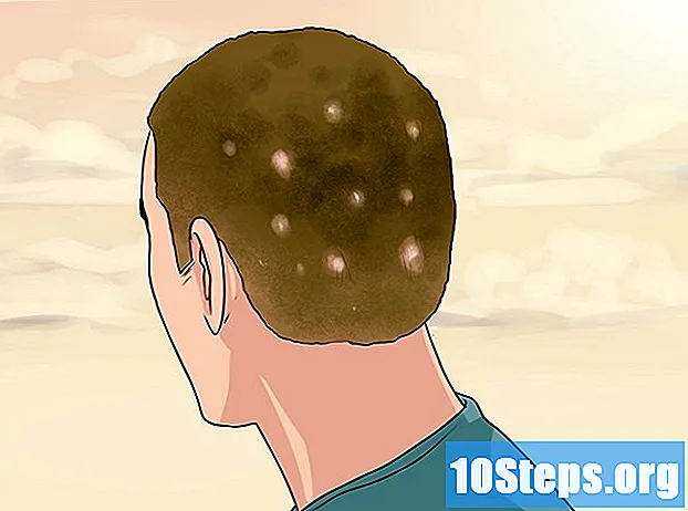 Ako diagnostikovať lupienku na hlave
