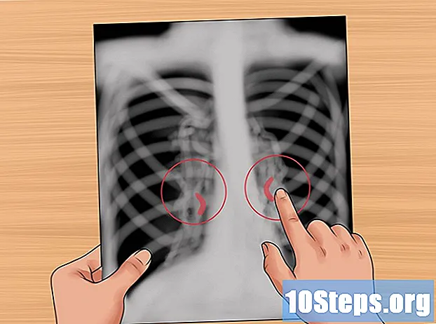Sådan læser du et røntgenbillede af brystet