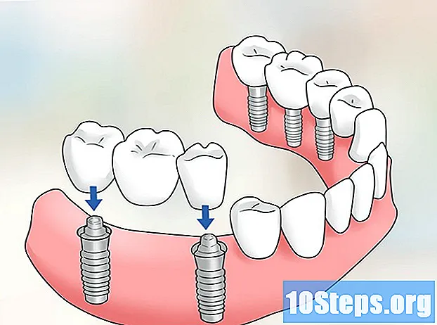 Cómo mantener la prótesis dental inferior en su lugar - Consejos