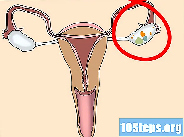 Kuinka tietää, jos sinulla on munasarjojen kysta - Vihjeitä