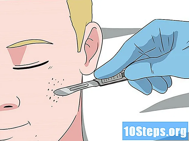 Cum să scapi de acneea chistică rapid