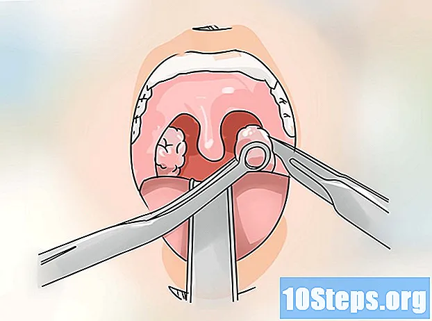 Come trattare la tonsillite