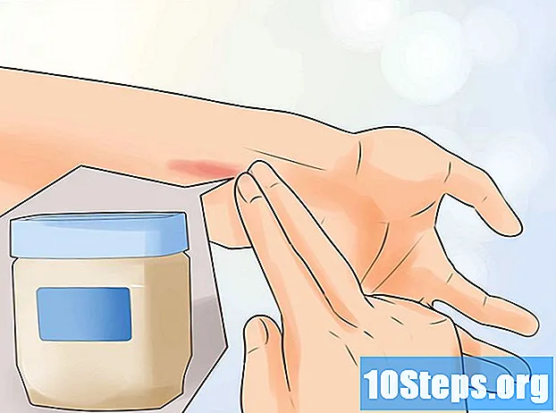 Как да лекуваме незначителни изгаряния